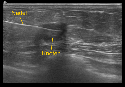 Sonographiegezielte Stanzbiopsie